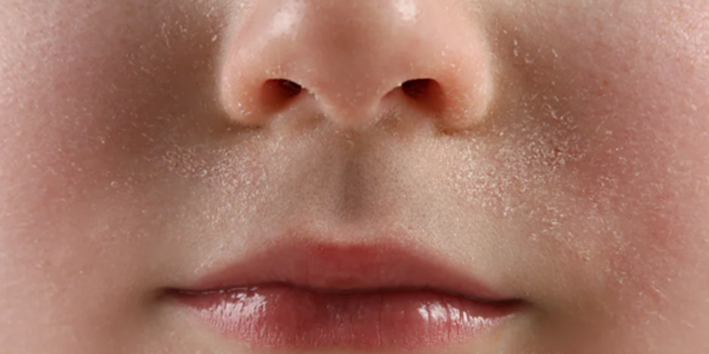 En este momento estás viendo ¿POR QUÉ SE RESECA LA PIEL EN INVIERNO?